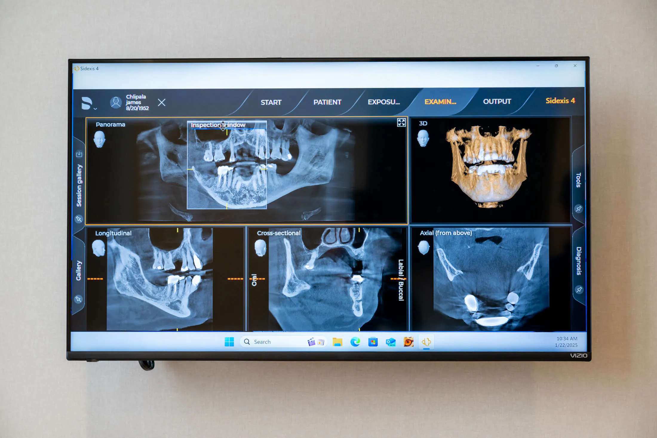 Panoramic X-ray evaluation